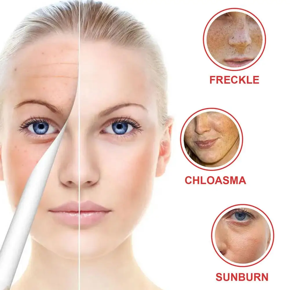 Učinkovito Beljenje Freckle Kremo Odstranite Melasma Acne Spot Pigment Melanin Temne Lise Pigmentacije Vlažilni Gel Za Nego Kože