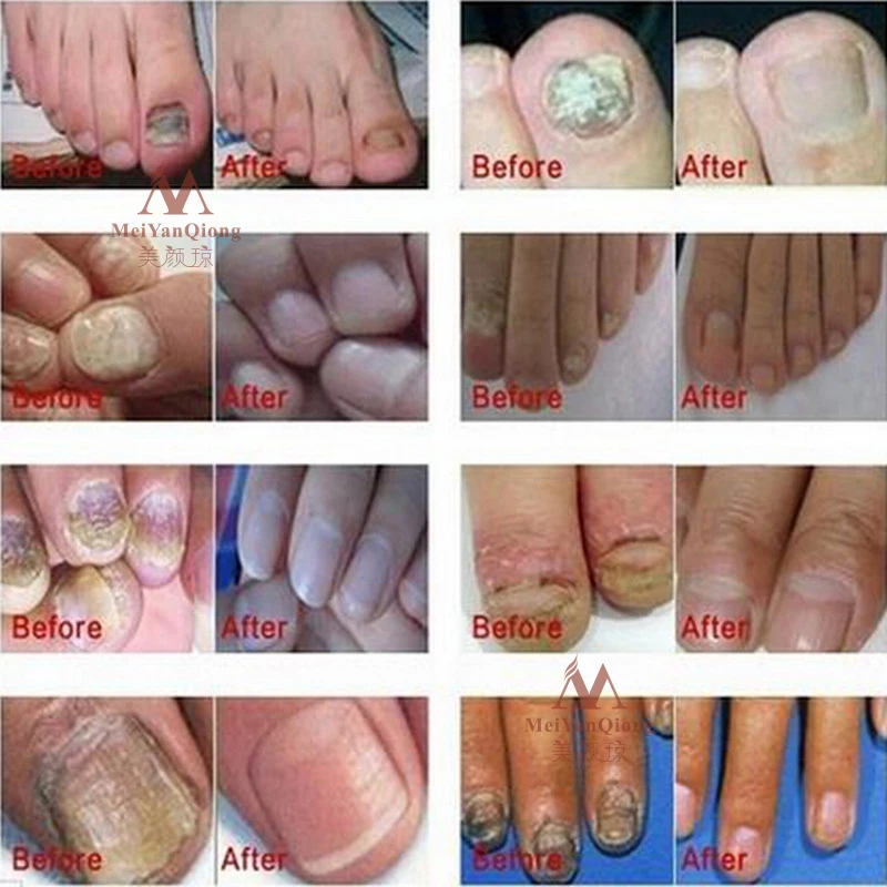 Uporabna Rastlina Nail Repair Cream Anti Glivične Okužbe Nohtov Za Onychomycosis Paronychia Kitajski Zeliščni Toe Nohtov Glive Zdravstvenega Varstva