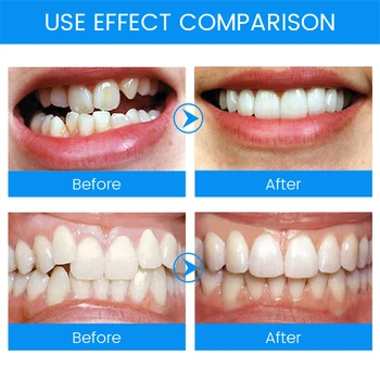 3 Stopnje Zobne Ortodontskega Oklepaji Zob Honorar Bruxism Usta Stražar Zob Ravnalec Stop Spalna Anti-Smrčanje Naprave